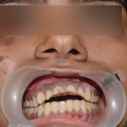 Root Canal Diagnosis in Akurdi & Chinchwad – Expert Check-up